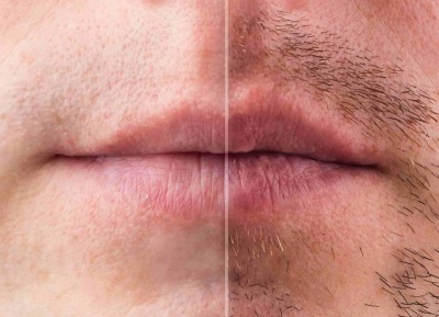 Mustache Transplantation