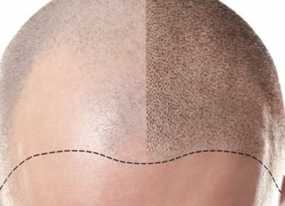 Hair Micropigmentation